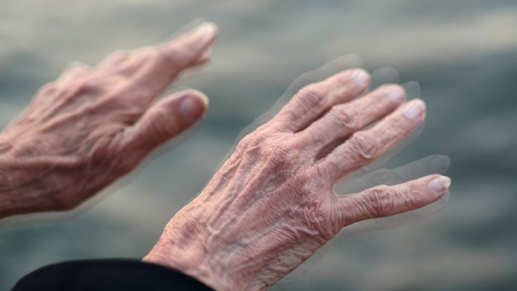 Parkinson, oltre al tremore