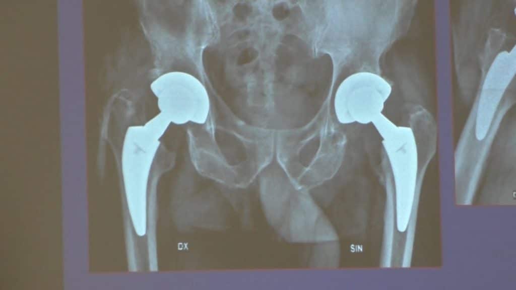"Anca bionica, rapida e indolore"