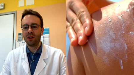 Varese: Voglia di sole? Dermatologo: “Usate creme 30-50”